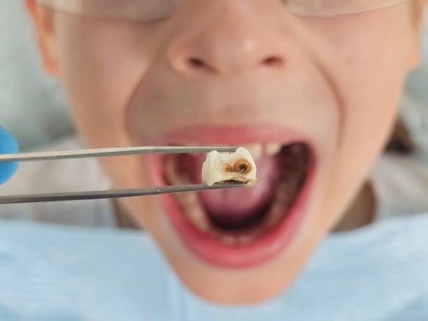 Best Pediatric Emergency Dentist in Cape Coral, FL